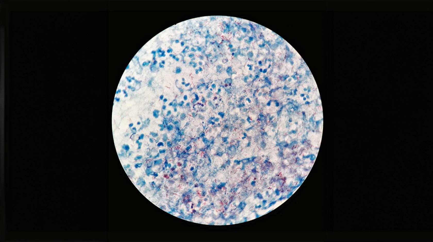 La lutte contre TB a été gelée dans le temps, jusqu'à présent. Voir son avenir.