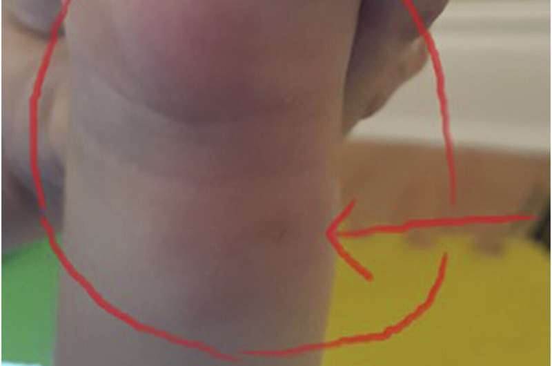 Étude de cas: Bartonella, Babesia, trouvée dans les tissus cérébraux de l'enfant avec des convulsions