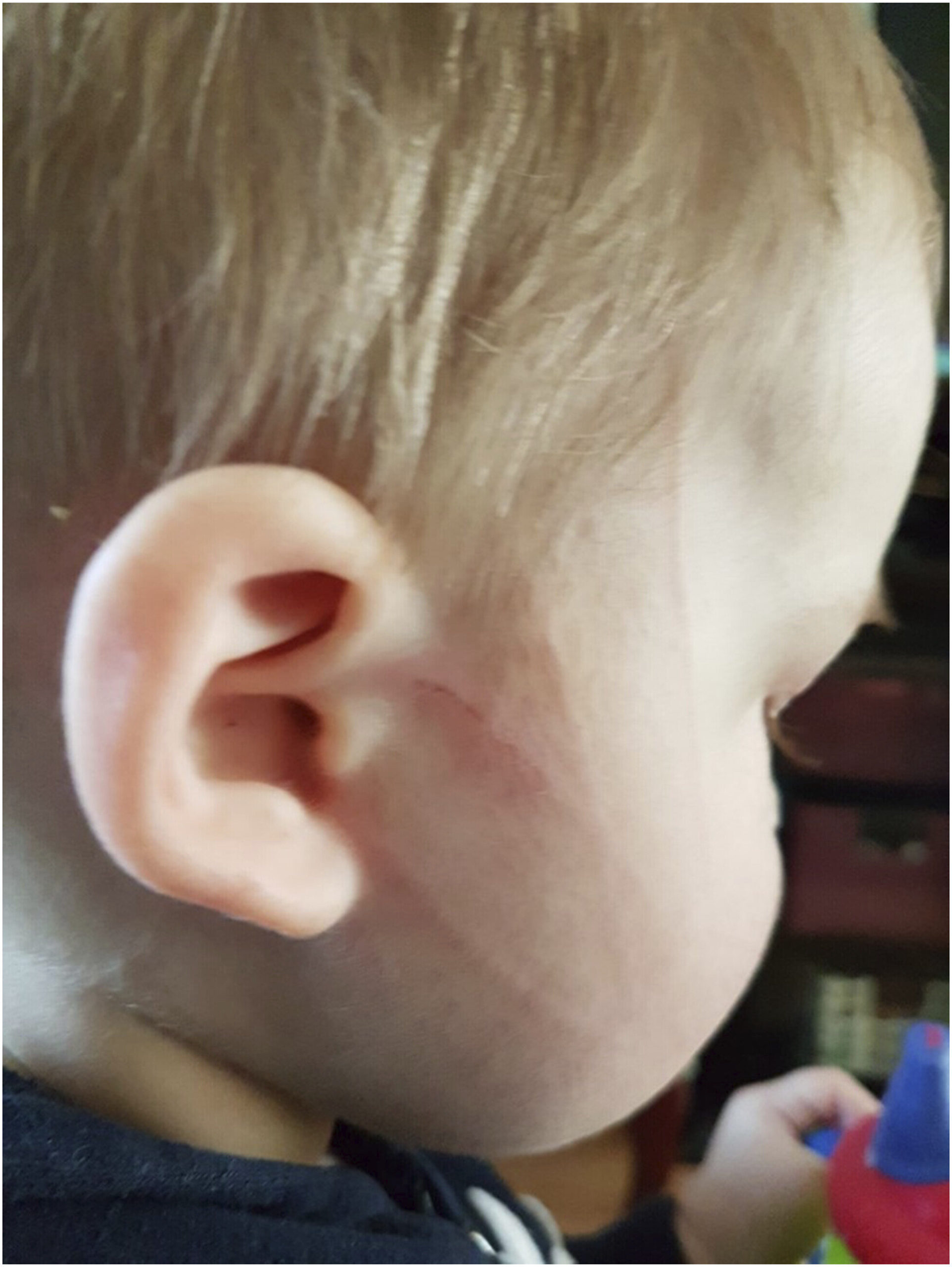 Bartonella et Babesia trouvés dans les tissus cérébraux de l'enfant avec des convulsions