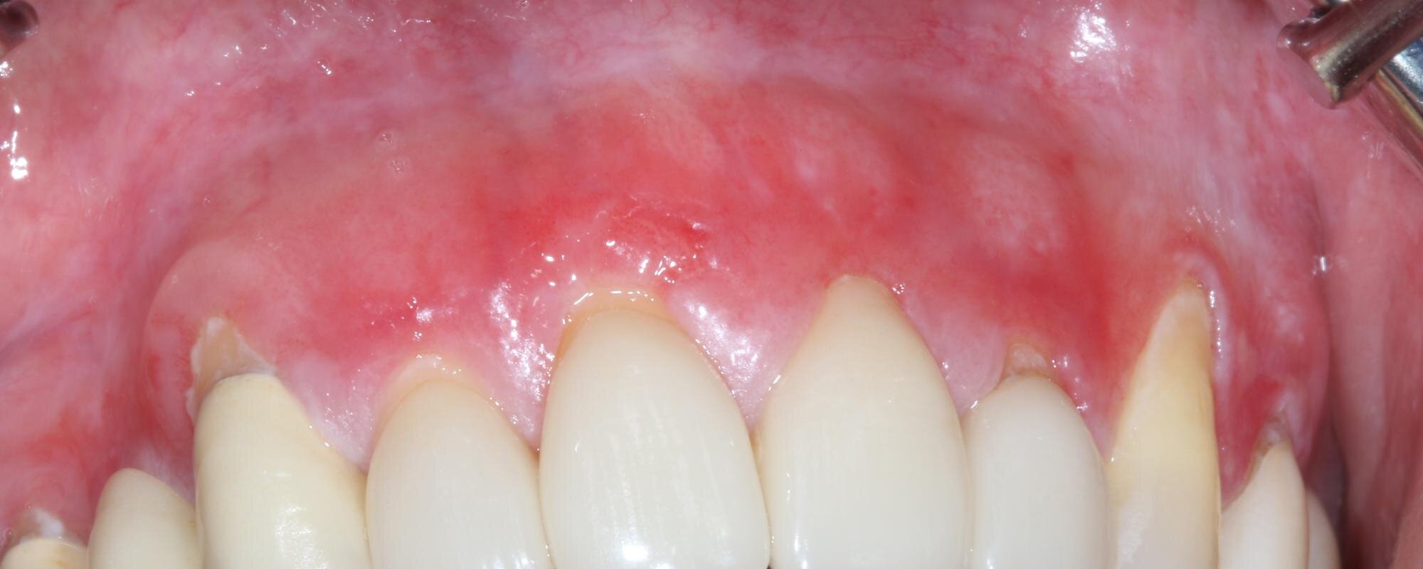 Inflammation grave des gencives trouvées après avoir utilisé du snus blanc