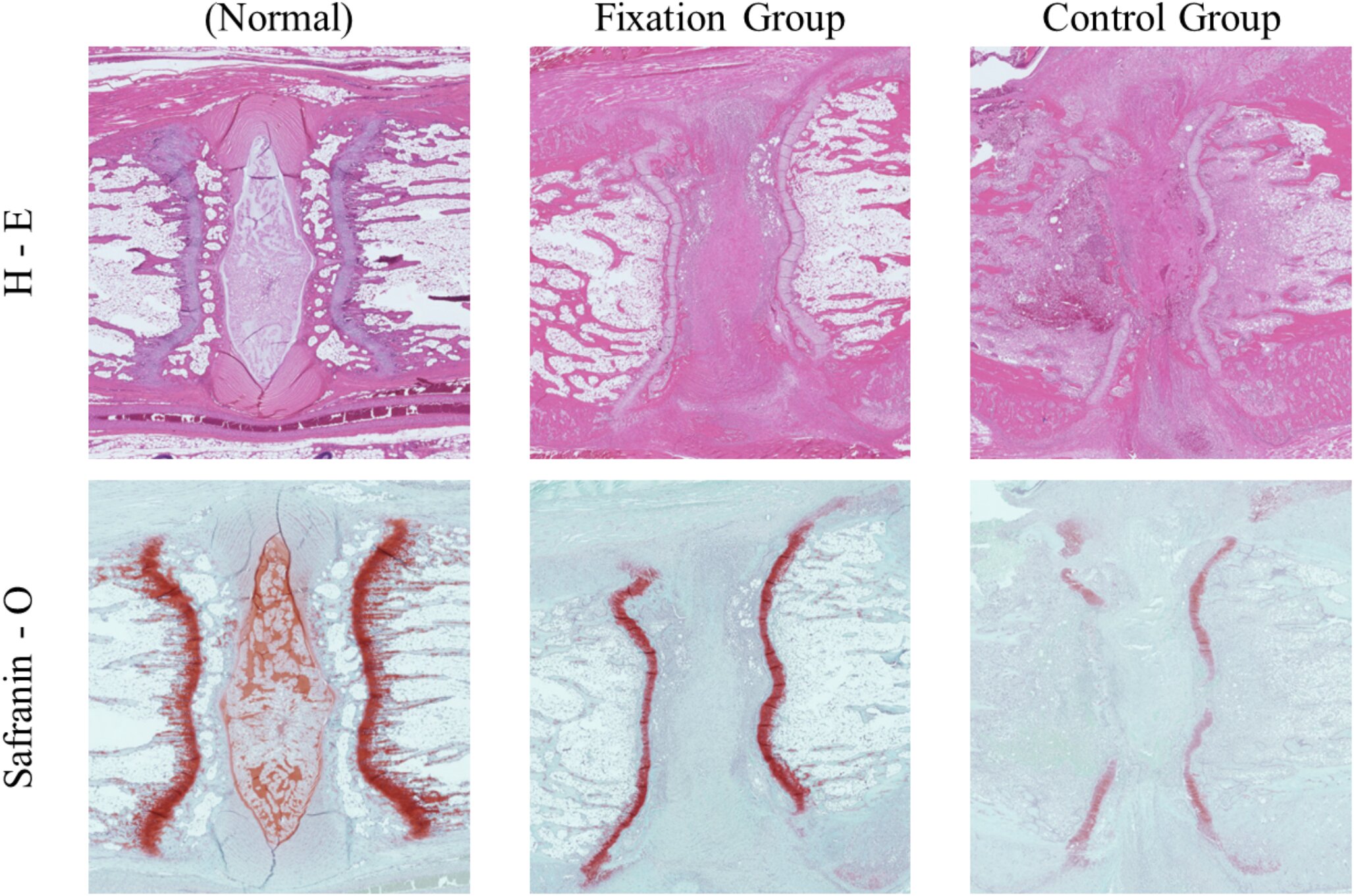La fixation chirurgicale peut limiter la perte osseuse des infections vertébrales, selon une étude