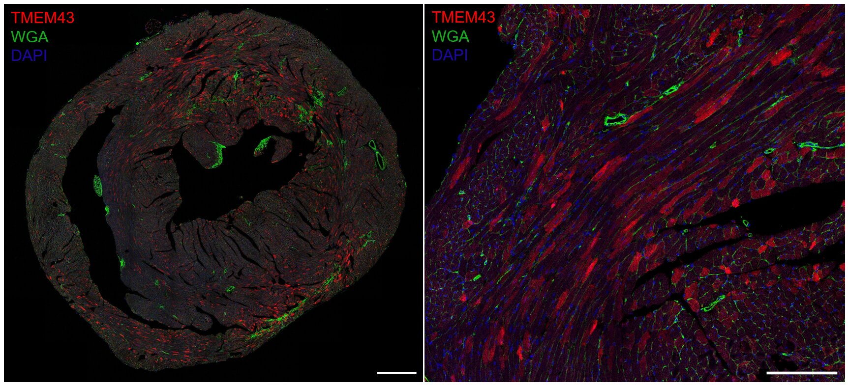 La thérapie génique offre de l'espoir pour des maladies cardiaques rares et mortelles chez les jeunes hommes