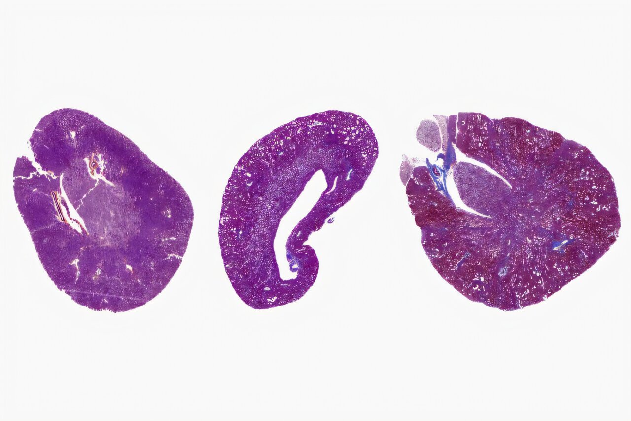 L'approche de la médecine de précision cible les cicatrices rénales pour éviter l'échec