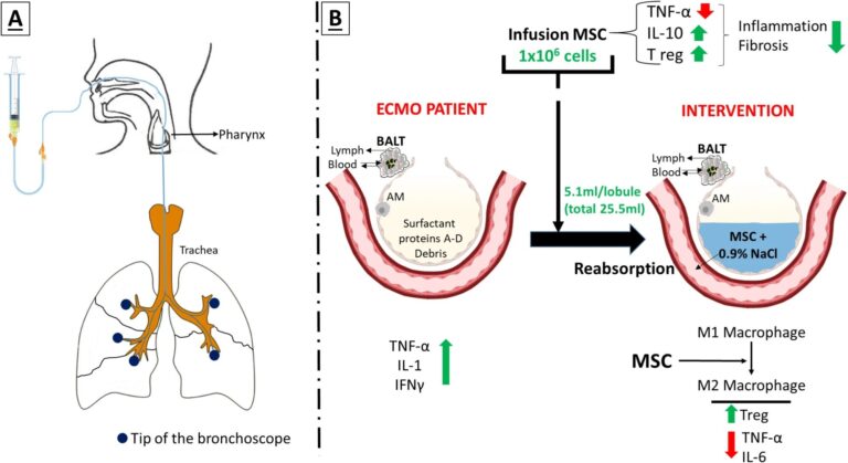 Une nouvelle méthode permet l'administration sûre de cellules souches chez les patients gravement malades sur le soutien pulmonaire externe