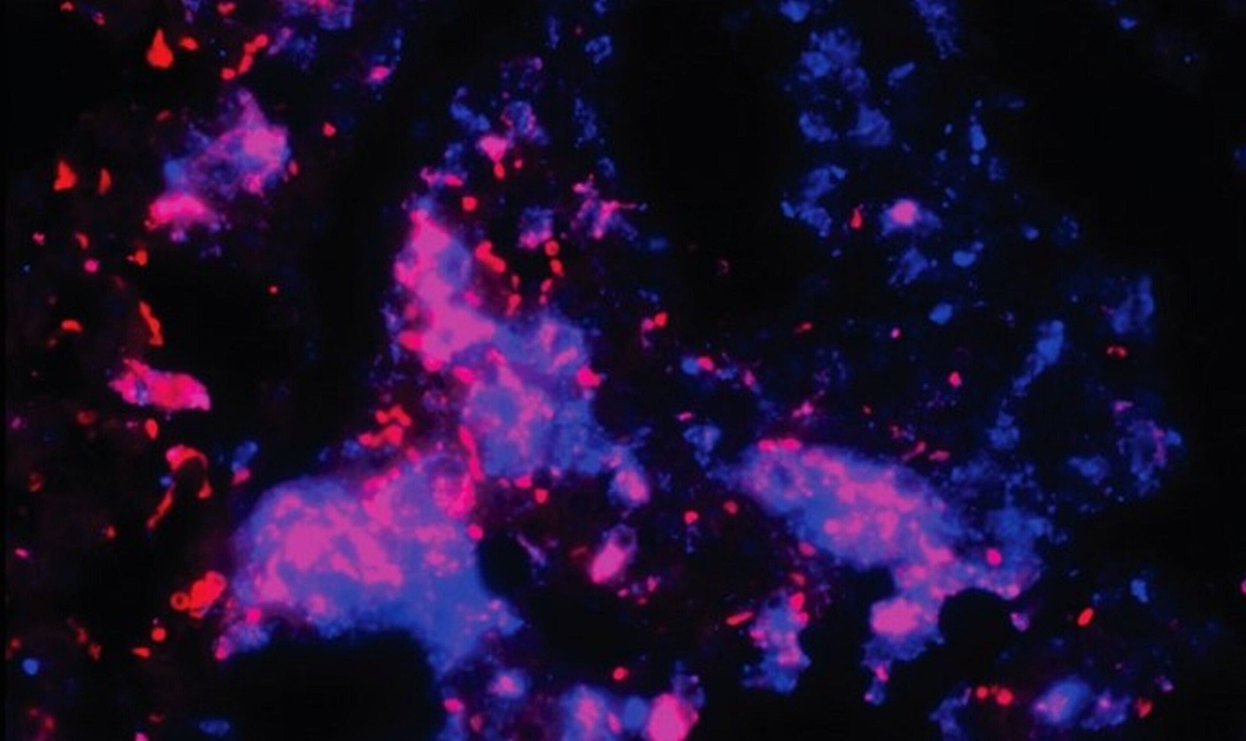 Le médicament contre le cancer expérimental pourrait rationaliser le traitement standard de la tuberculose et prévenir la maladie pulmonaire post-TB