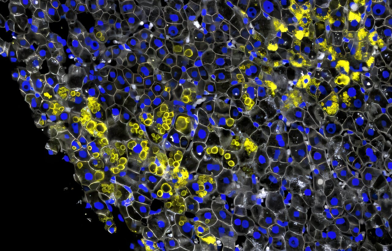 L'étude révèle pourquoi certains patients atteints de maladie héréditaire restent en bonne santé