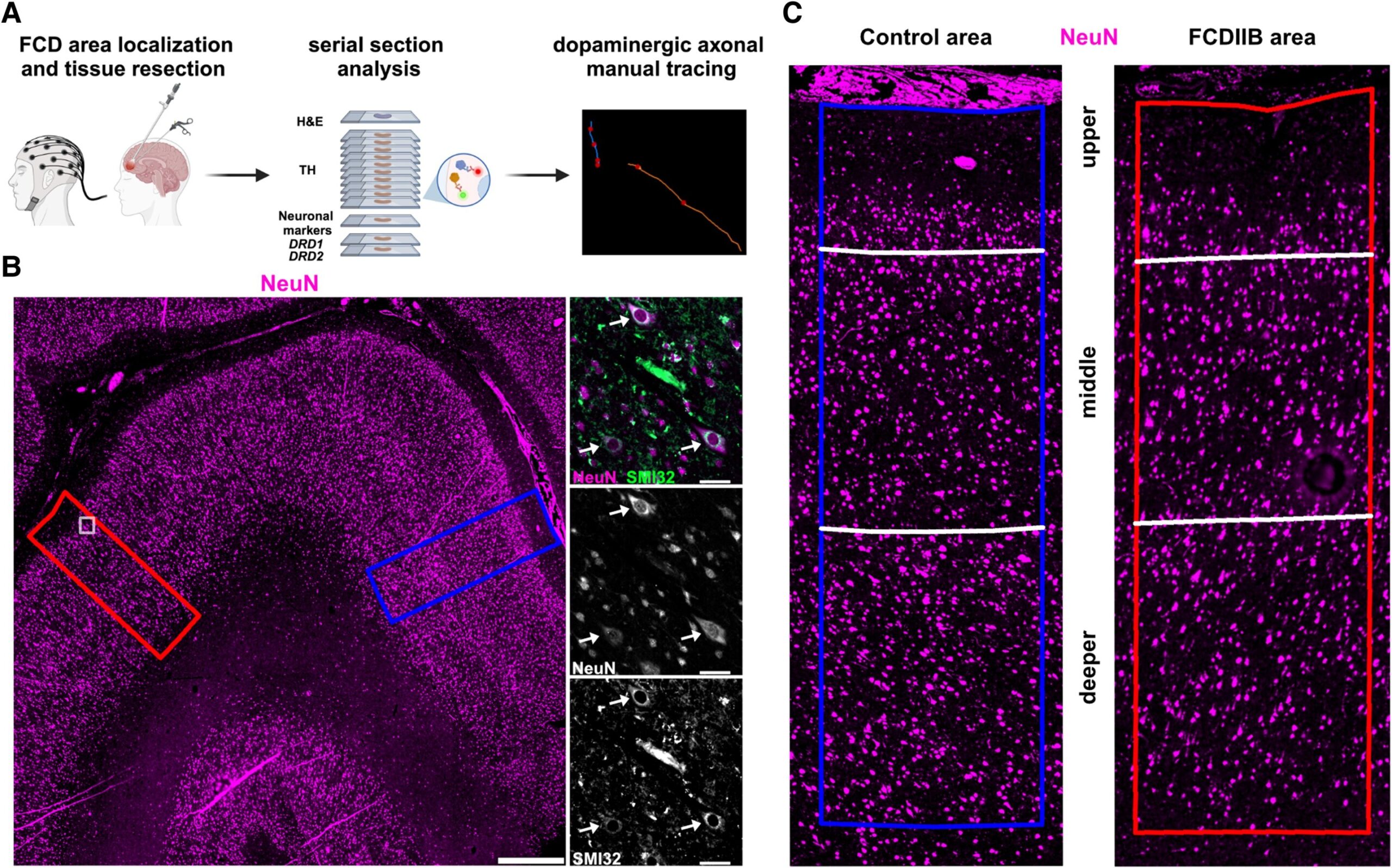 Les voies de signalisation de la dopamine perturbée pourraient favoriser les crises d'épilepsie dans la dysplasie corticale focale