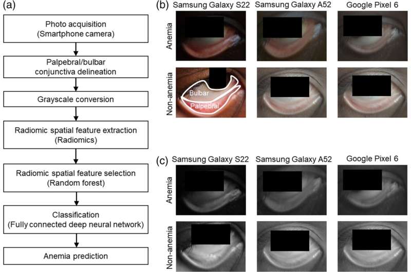 Les photos des yeux de smartphone peuvent aider à détecter l'anémie chez les enfants