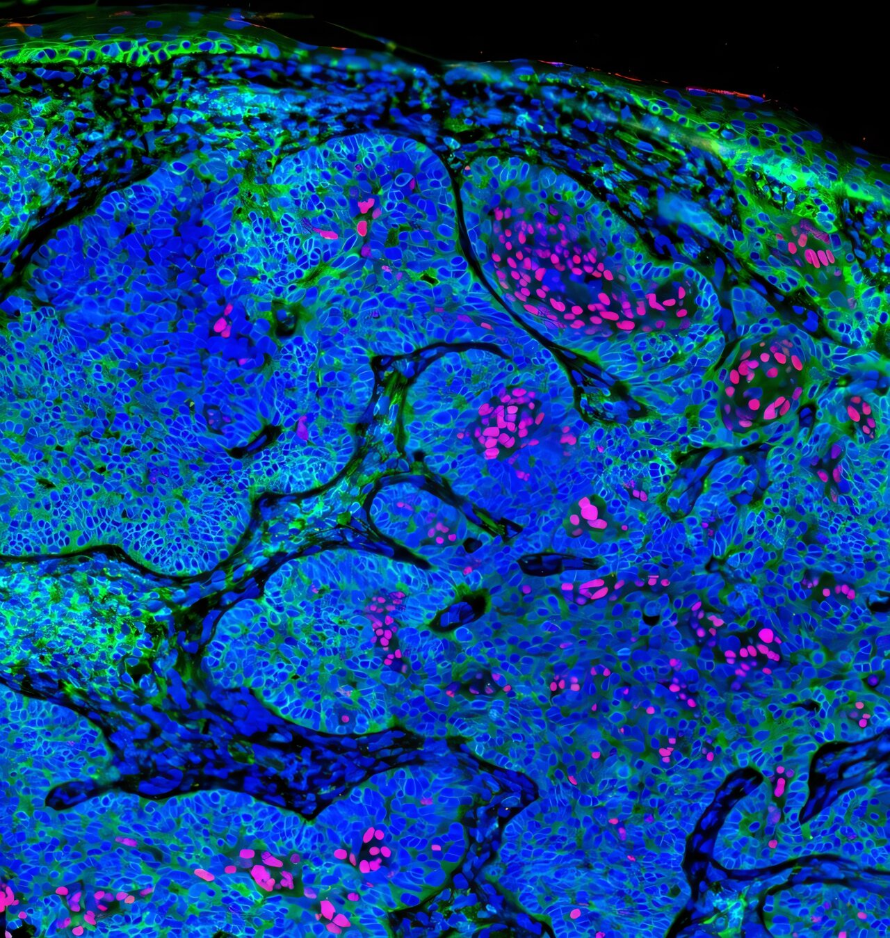 L'immunogénicité faible du carcinome basal lié à la suppression de la présentation de l'antigène de sa cellule d'origine