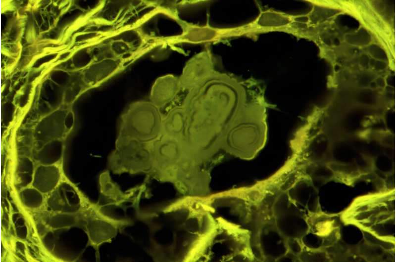 Les calcifications bénignes des maladies mammaires sont caractérisées par des nodules sphériques avec des couches intérieures concentriques. Crédit: Mayandi Sivaguru L'étude trouve des différences entre les calcifications bénignes et cancer du sein - Bureau des nouvelles
