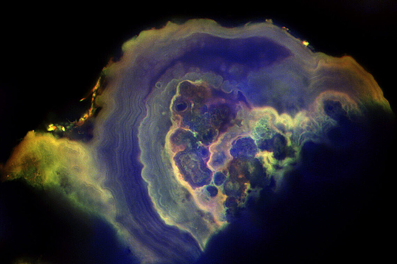 Une nouvelle analyse identifie les différences entre les calcifications bénignes et le sein cancéreux
