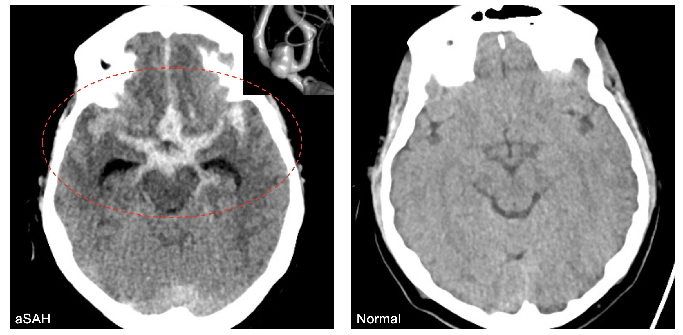 La recherche relie la pollution de l'air à un risque accru de saignement dans le cerveau
