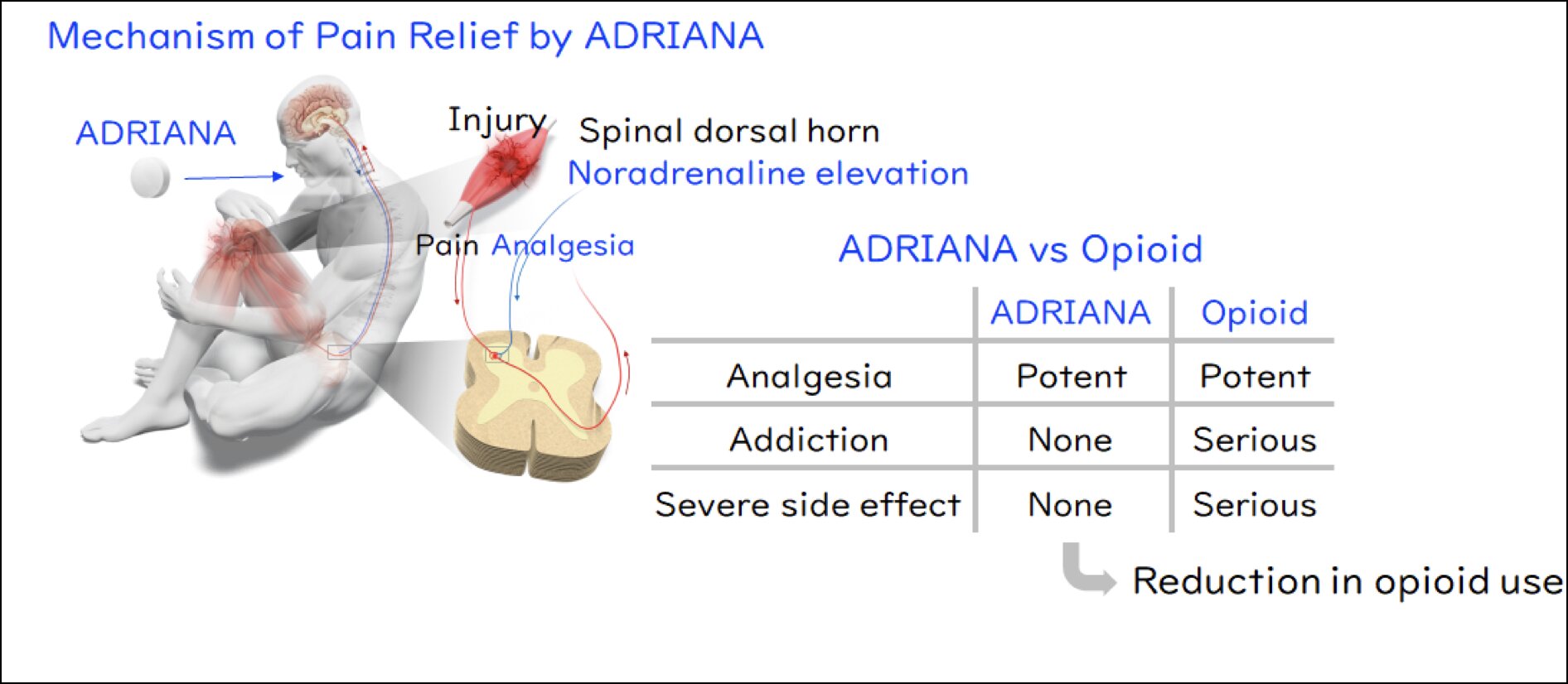 La découverte d'un nouvel analgésique promet un soulagement de la douleur avec moins de inconvénients