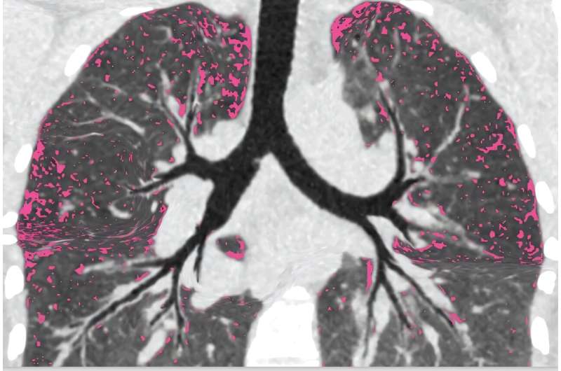 Avoir un coup d'œil sur les infections pulmonaires