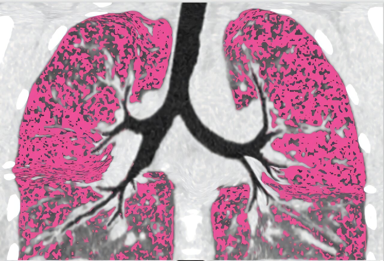 Dommages pulmonaires non principaux des infections persistantes dans la fibrose kystique, l'étude révèle