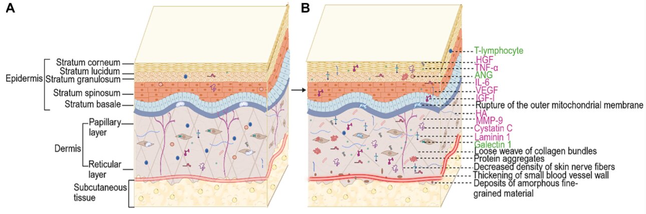 Les biomarqueurs à base de peau peuvent offrir un diagnostic plus précoce pour la sclérose latérale amyotrophique