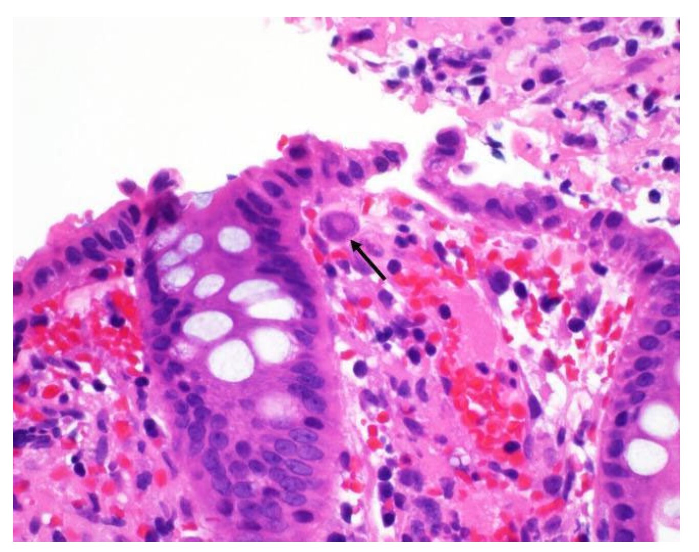 Sensibilisation à la colite de cytomégalovirus