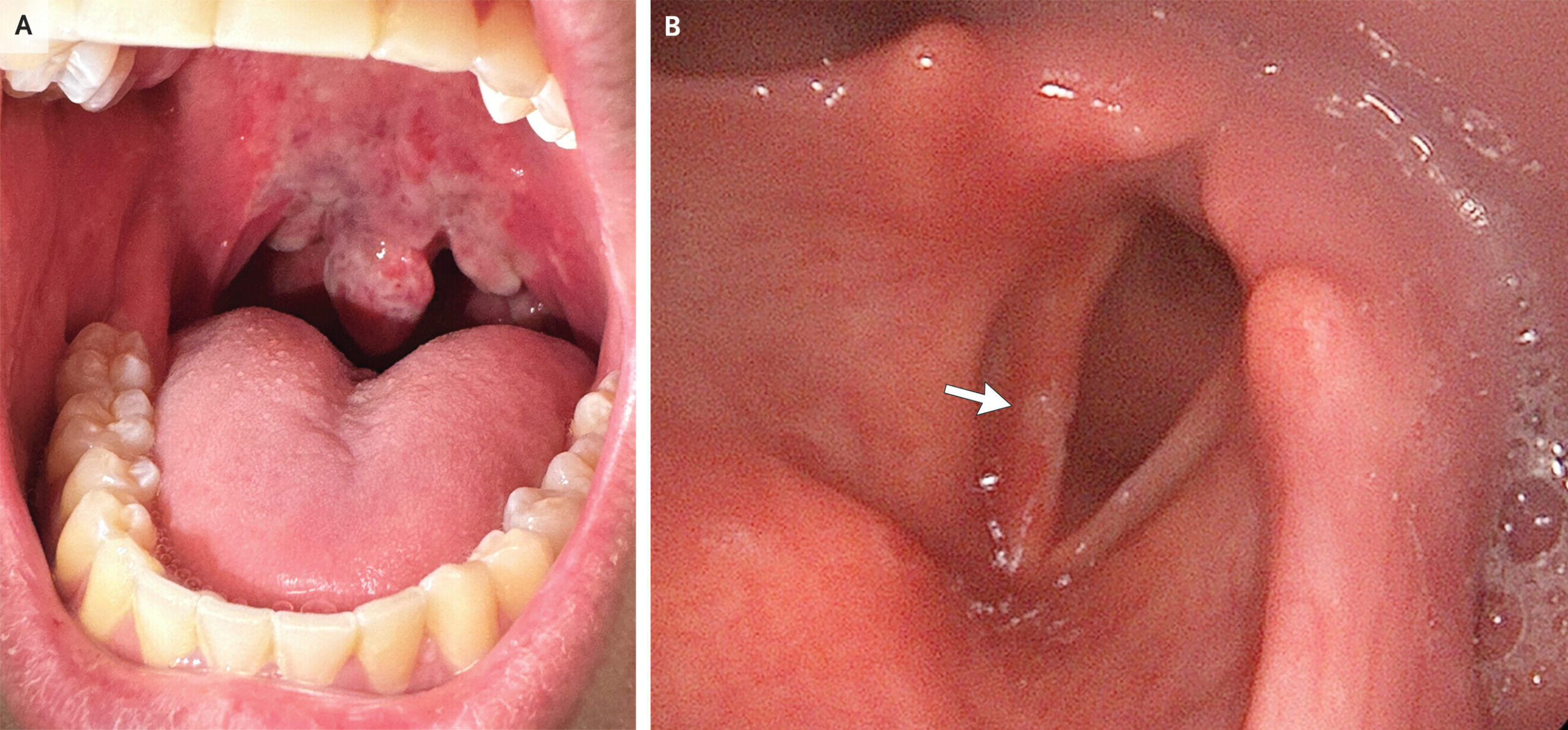 Un spectacle courant lors des concerts, l'abus d'oxyde nitreux en flèche, ce qui fait que des problèmes de santé