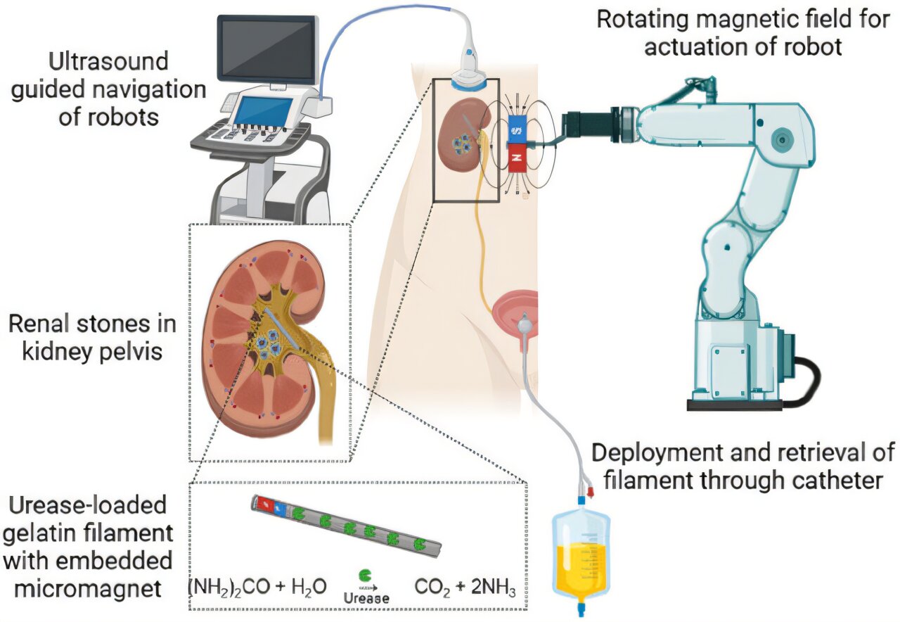 Les robots mous vont directement sur le site des calculs rénaux