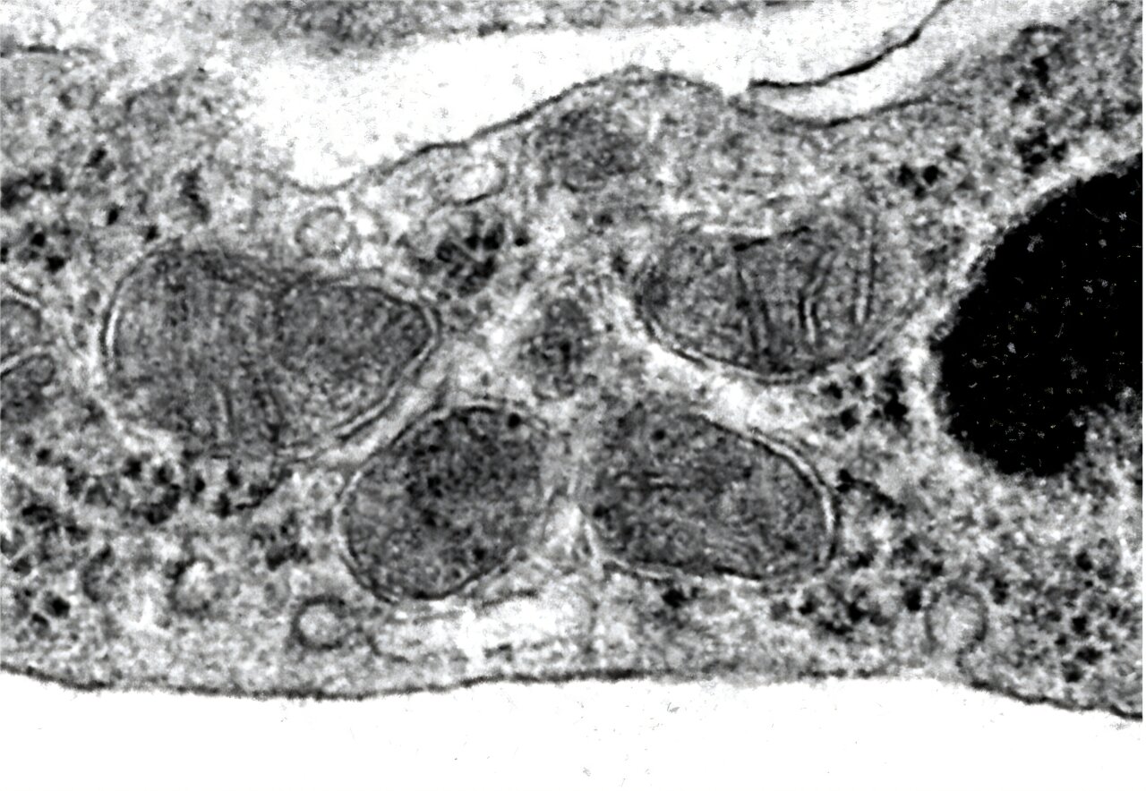 La réorientation d'un médicament au cholestérol peut bénéficier aux patients atteints du syndrome de Digeorge atteints de maladie neuropsychiatrique