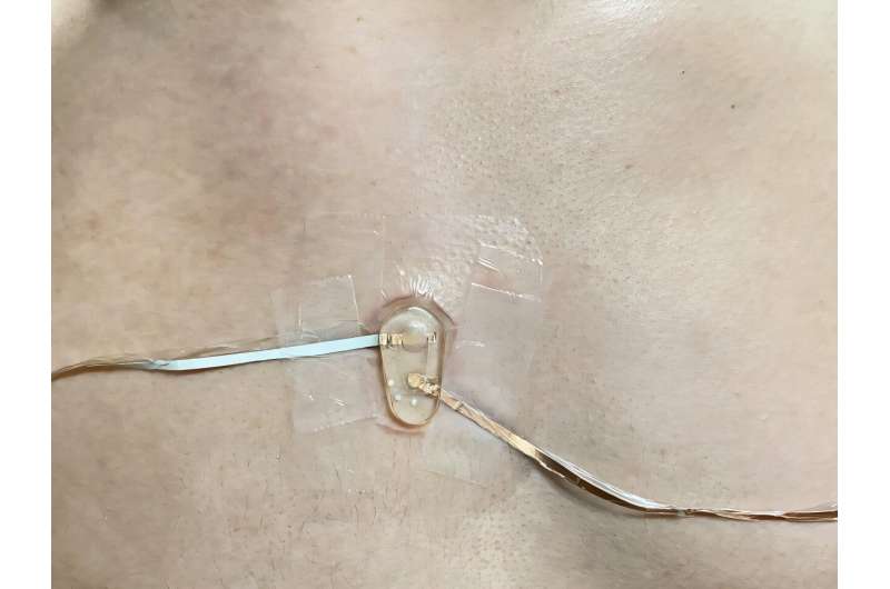 Briser une sueur: utiliser du chlorure dans la sueur pour aider à diagnostiquer la fibrose kystique