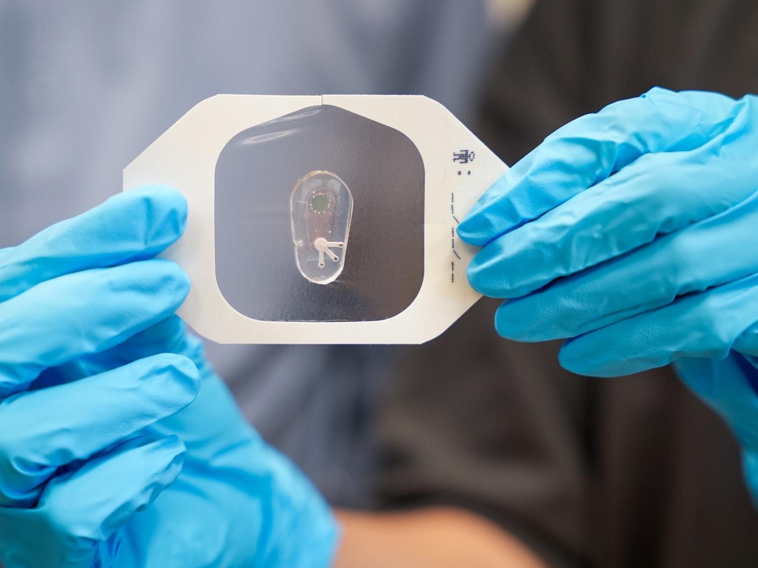 Utilisation du chlorure dans la sueur pour aider à diagnostiquer la fibrose kystique