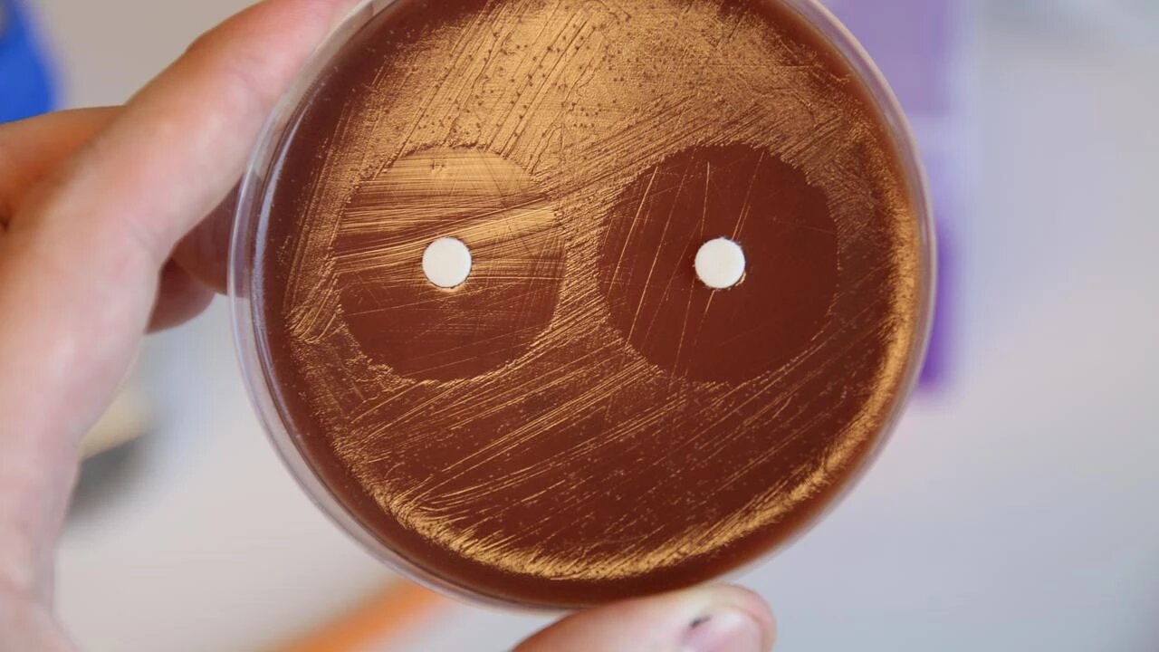 Les cas de gonorrhée augmentent à mesure que la résistance aux antibiotiques limite les options de traitement