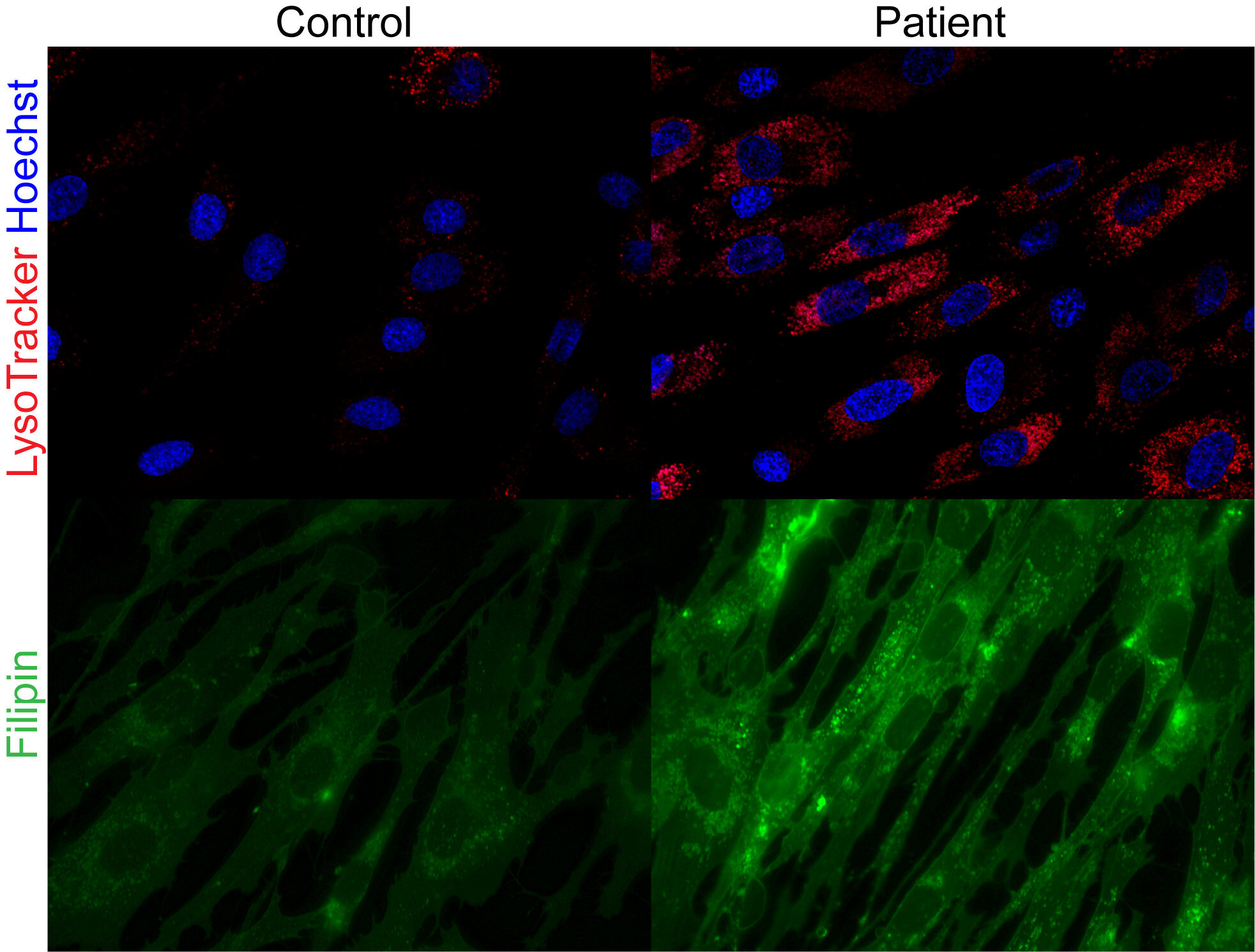 Les scientifiques résolvent le mystère médical derrière une maladie multi-organes rares, ouvrant la porte à de nouveaux traitements