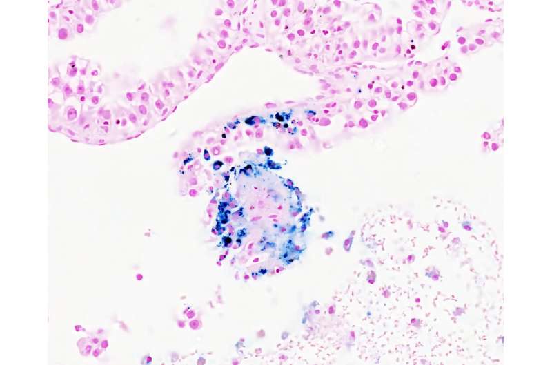 De nouvelles recherches de l'Université de Princeton découvrent pourquoi les métastases osseuses conduisent souvent à l'anémie