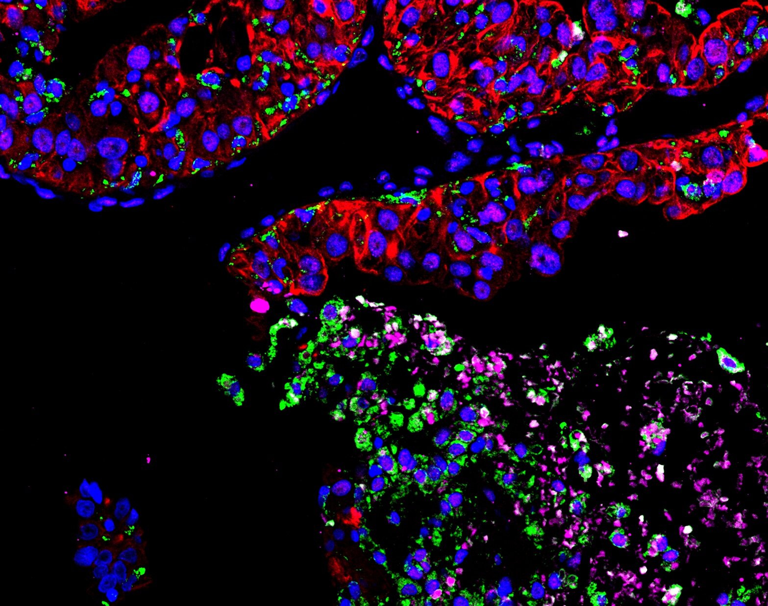 La recherche découvre pourquoi les métastases osseuses conduisent souvent à l'anémie