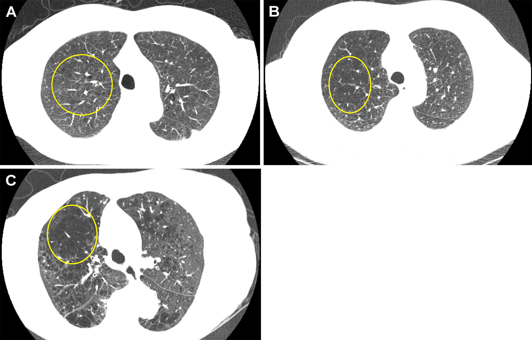Emphysème au dépistage pulmonaire CT lié à un risque plus élevé de décès chez les adultes asymptomatiques