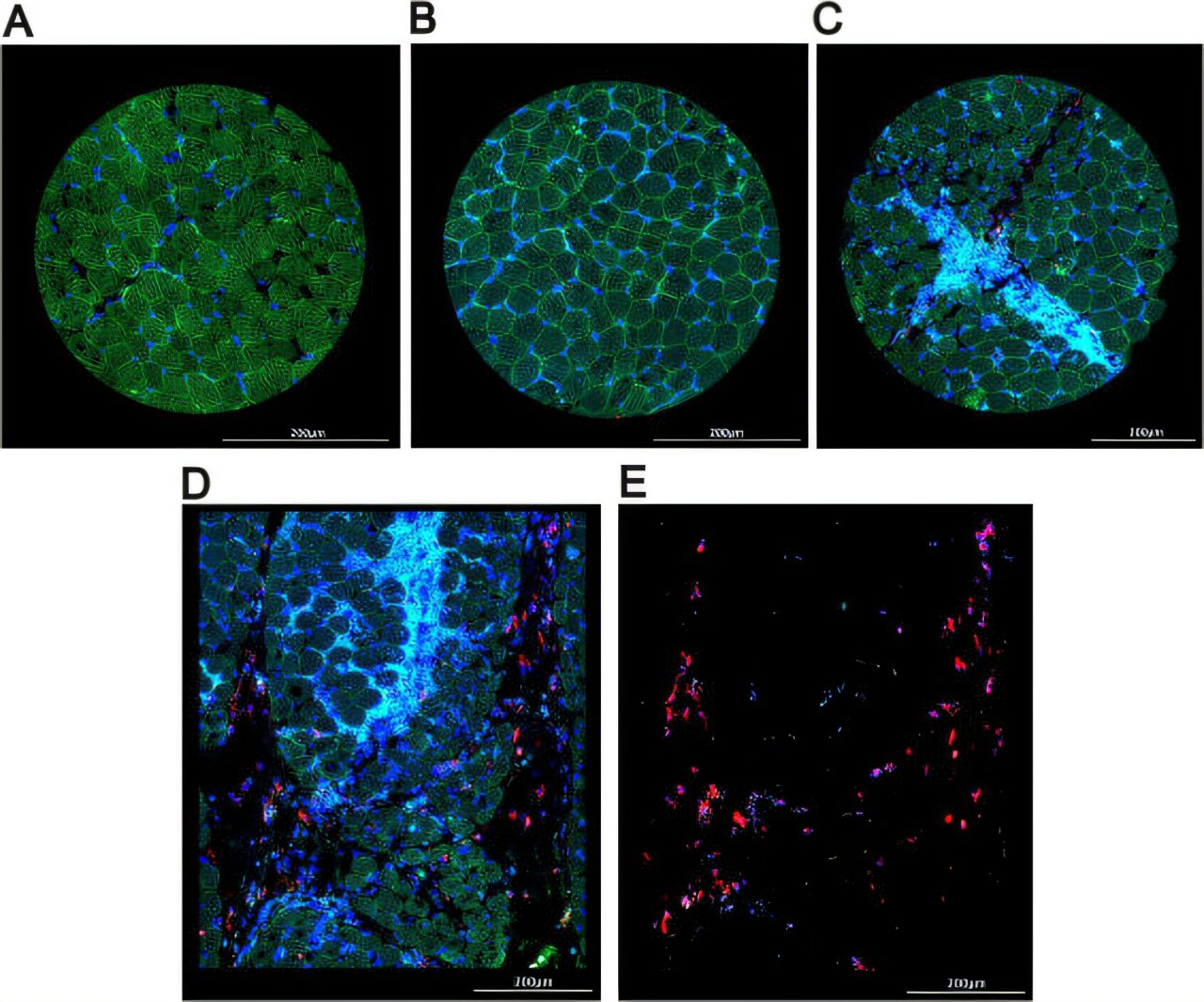 Les recherches actuelles peuvent ouvrir des portes aux nouveaux traitements pour les enfants atteints de dermatomyosite juvénile