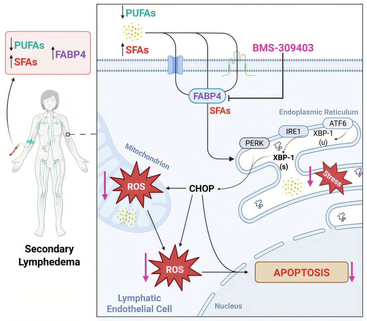 L'étude montre que le changement dans l'alimentation pourrait réduire le lymphœdème