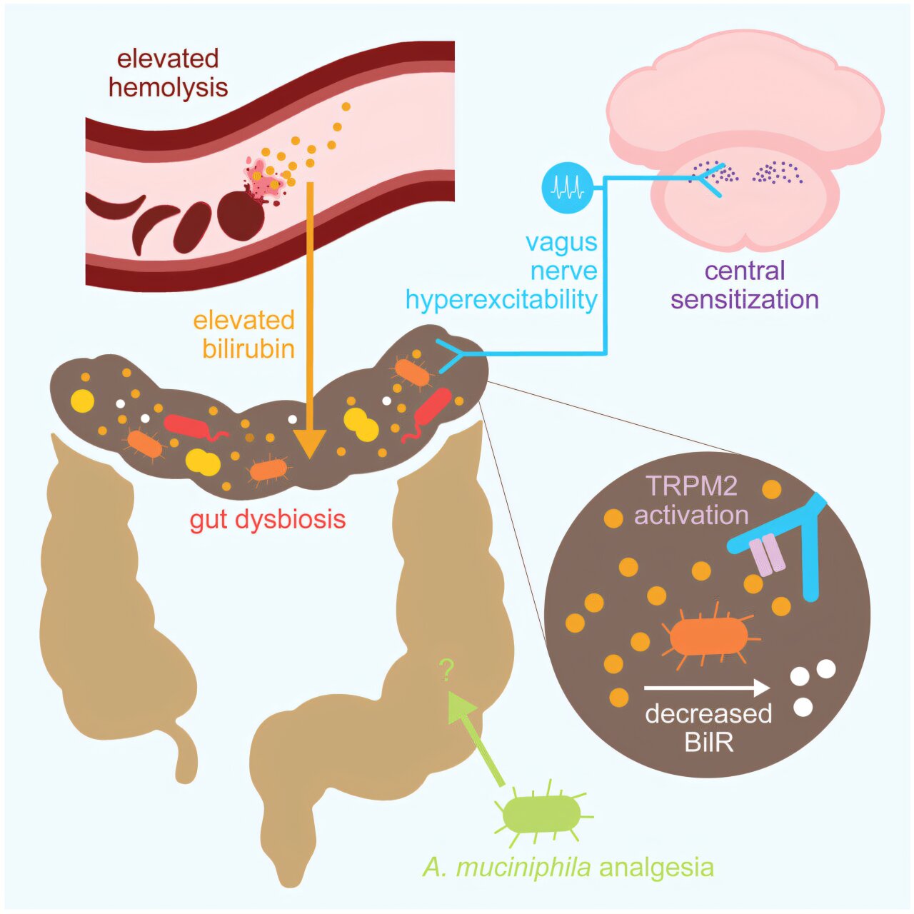 Douleur de drépanocytose chronique liée au déséquilibre microbien intestinal