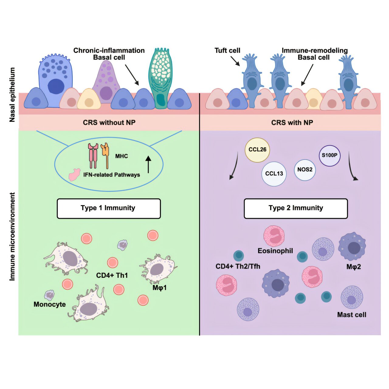 Pourquoi certains polypes de sinus continuent de revenir et comment les aborder