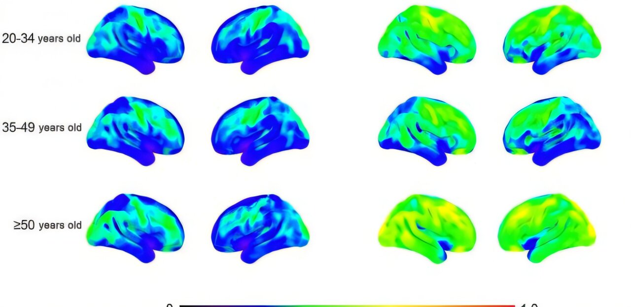 La neuroinflammation précoce chez les personnes atteintes du syndrome de Down peut expliquer une prévalence élevée de la maladie d'Alzheimer