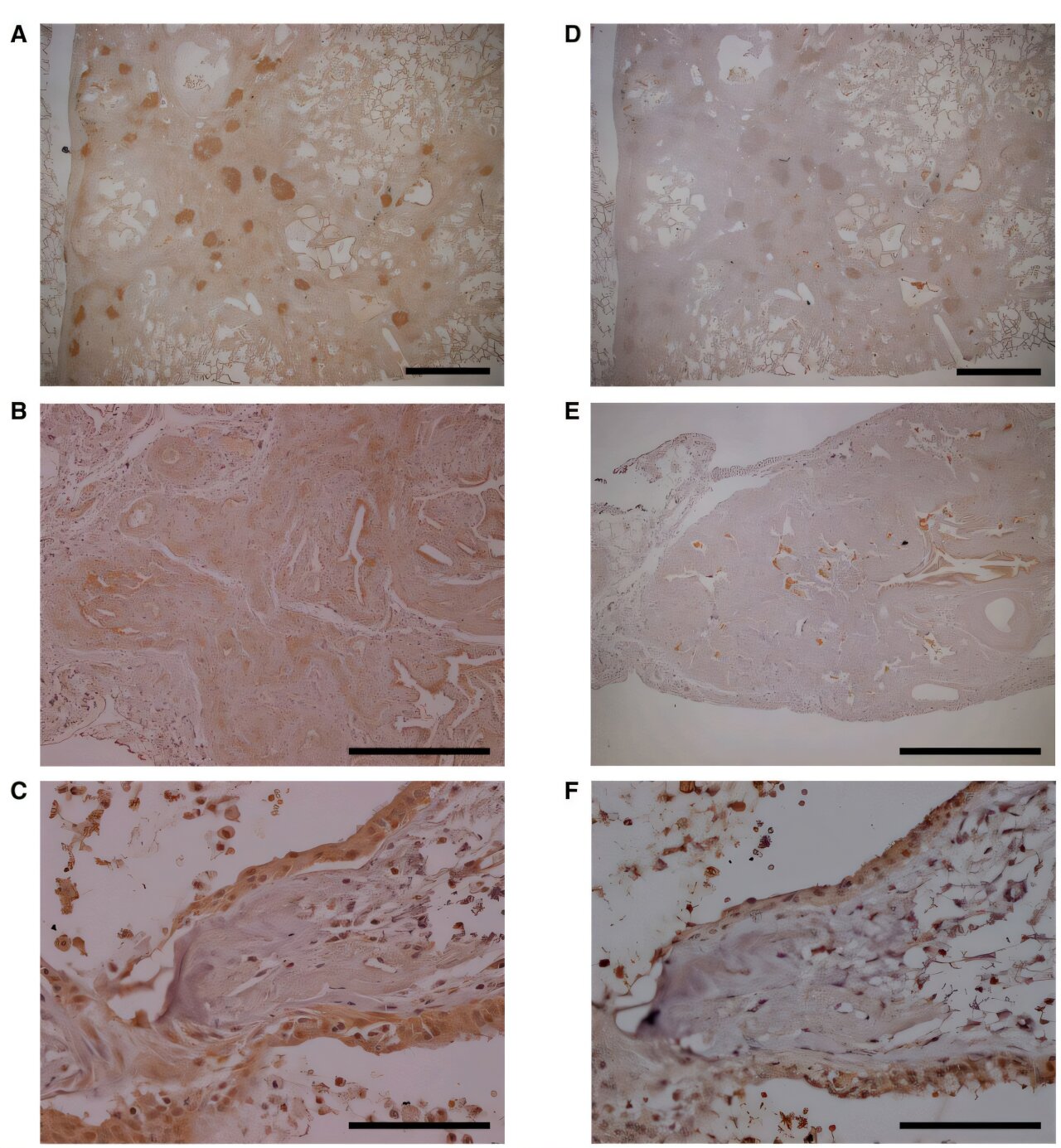 Identifier les personnes à risque de cicatrices pulmonaires dangereuses avant même l’apparition des symptômes