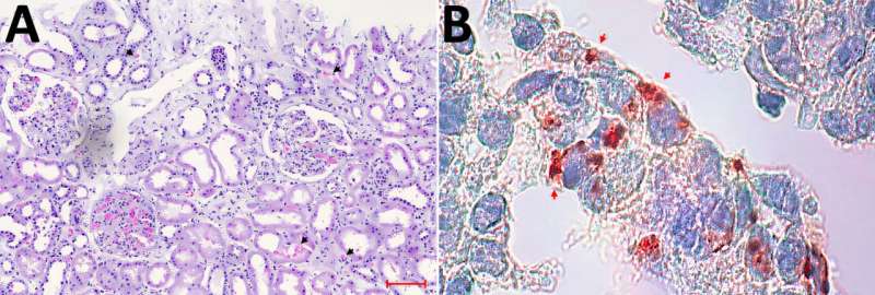 Analyse au microscope optique et résultats de coloration immunohistochimique de la biopsie rénale du patient index indiquant une infection grave par le virus de Séoul avec lésion rénale aiguë, Allemagne, mars 2024. A) Microscopie optique de la biopsie colorée à l'hématoxyline et à l'éosine démontrant une lésion tubulaire aiguë sévère avec saignement interstitiel et tubulaire (têtes de flèches noires), œdème tissulaire et inflammation interstitielle. La barre d’échelle indique 100 μm. B) Coloration immunohistochimique (rouge) à l'aide d'un anticorps antihantavirus monoclonal de souris (Progen Biotechnik, https://www.progen.com) et du kit chromogène DCS-AEC (Agilent-DAKO, https://www.agilent.com) montrant l'antigène hantavirus dans les cellules tubulaires rénales (têtes de flèches rouges). Grossissement d'origine ×100. Crédit : Maladies infectieuses émergentes (2025). DOI : 10.3201/eid3110.250362 Un virus rare transmis par des rats infecte une femme en Allemagne – lien avec un établissement privé d'élevage de rats de compagnie