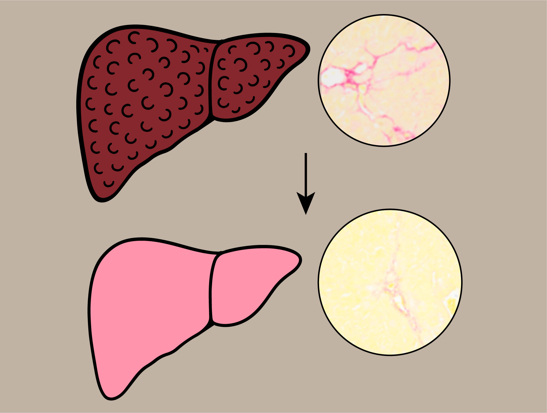 Traiter la fibrose avec un produit chimique dérivé de Lawsonia inermis