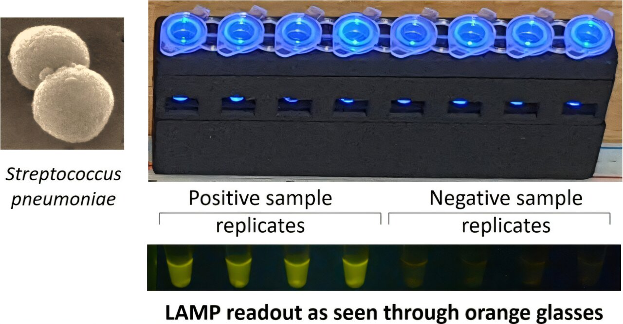 Une méthode de diagnostic innovante permet une détection rapide et abordable de la pneumonie dans les contextes à faibles ressources
