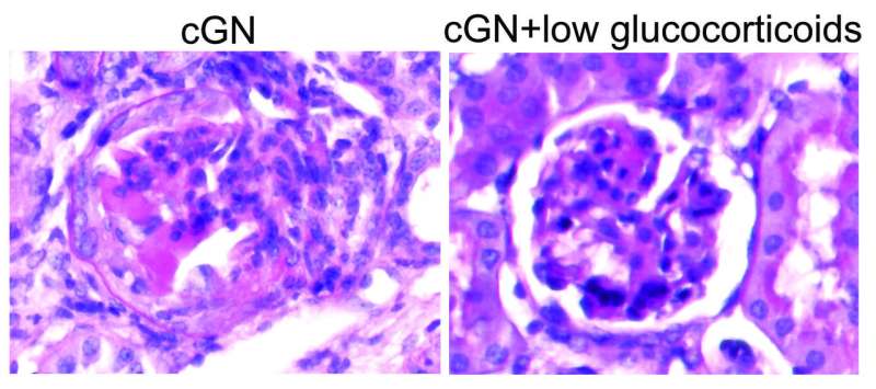 Moins peut être plus : des stéroïdes à faible dose pourraient traiter efficacement une inflammation rénale sévère