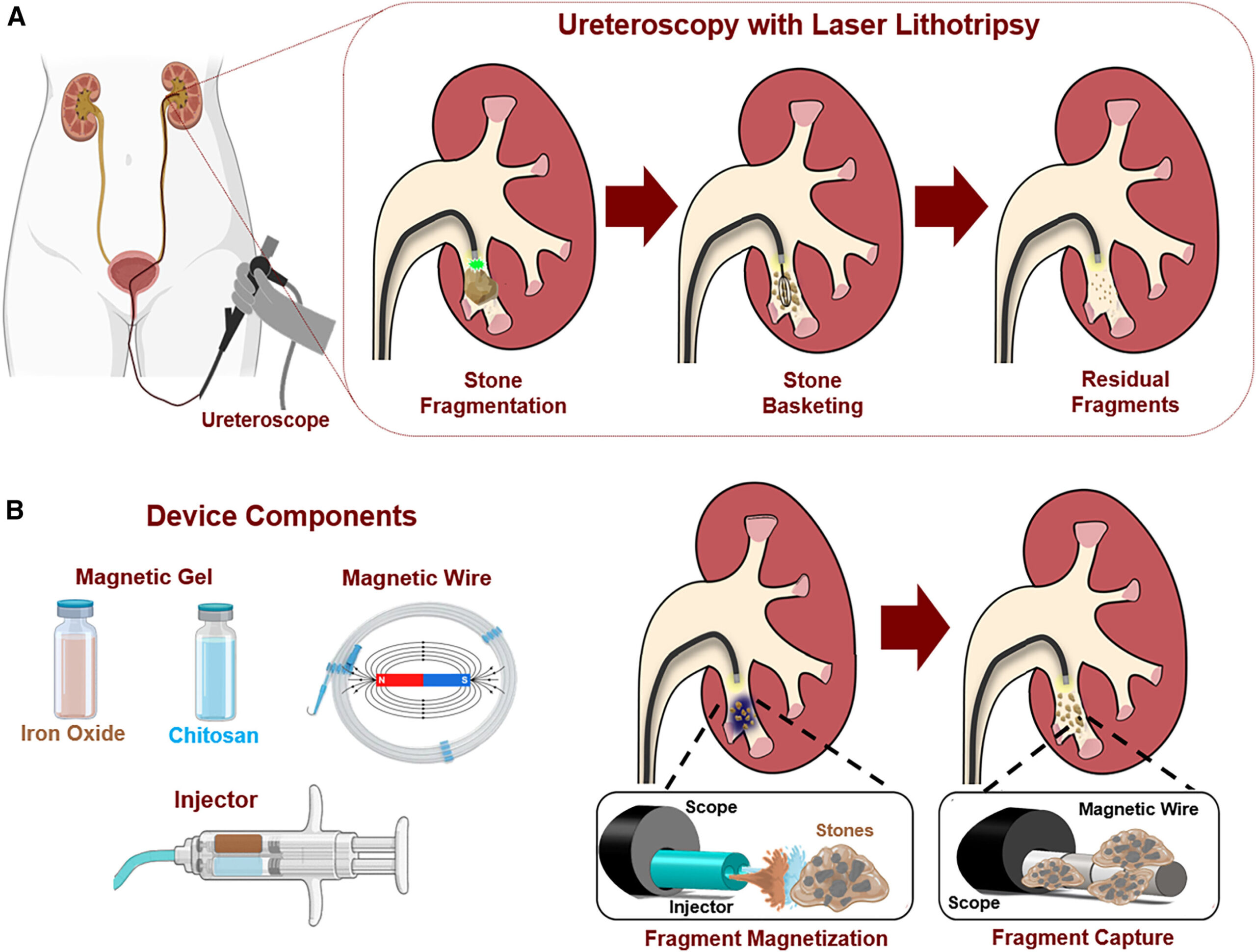 L’approche magnétisée de la récupération des calculs rénaux surpasse les méthodes standard dans les études précliniques