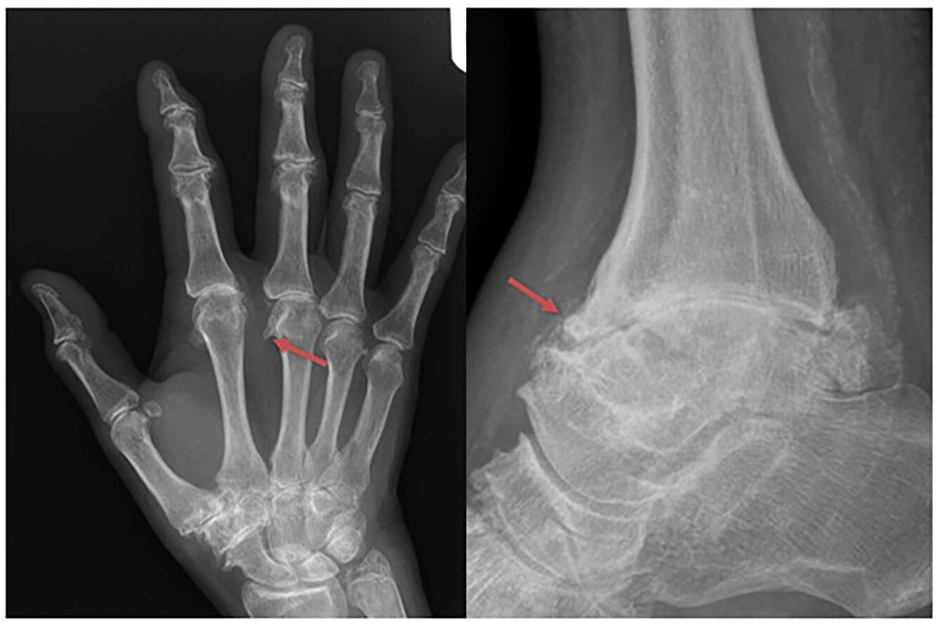 Critères de classification pour l'arthropathie hémochromatose développés