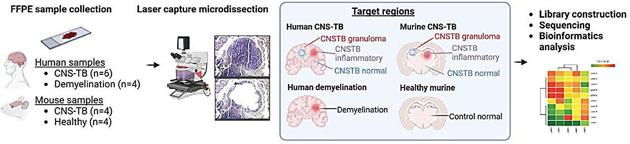 Un antibiotique réutilisé semble prometteur contre la tuberculose du système nerveux central