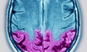 Ataxie : symptômes, causes, conséquences et quand consulter un médecin