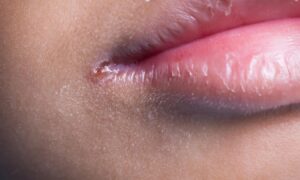 Coins de la bouche déchirés : Cause et traitement des coins de la bouche