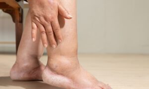 Œdème : causes, symptômes et quand consulter un médecin