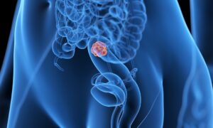 Si vous présentez deux symptômes, vous devez immédiatement subir une coloscopie.