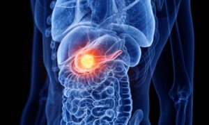 La vaccination à l’ARNm offre un espoir contre le cancer du pancréas