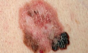 Le cancer de la peau noire survient souvent sur les jambes chez les femmes